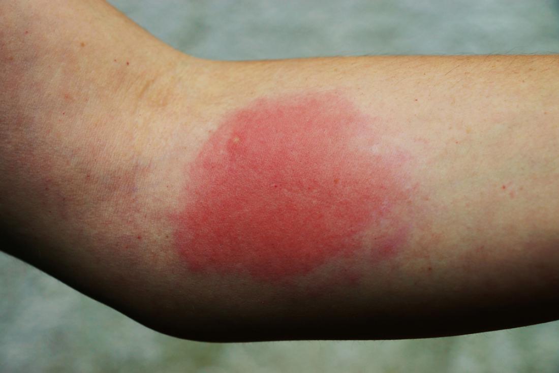 Alergijska reakcija ob piku ose. FOTO: Siegi/Shutterstock
